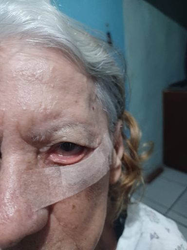 Idosa de Arraial do Cabo corre risco de perder olho enquanto aguarda cirurgia emergencial há 5 meses — RC24H