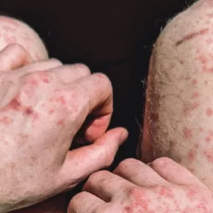 MPRJ acompanha políticas públicas de prevenção e enfrentamento à sífilis em Macaé e Rio das Ostras — RC24H